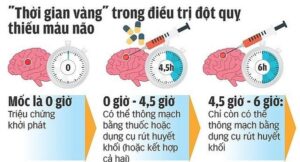 “Giờ vàng” trong cấp cứu, điều trị bệnh nhân đột quỵ não
